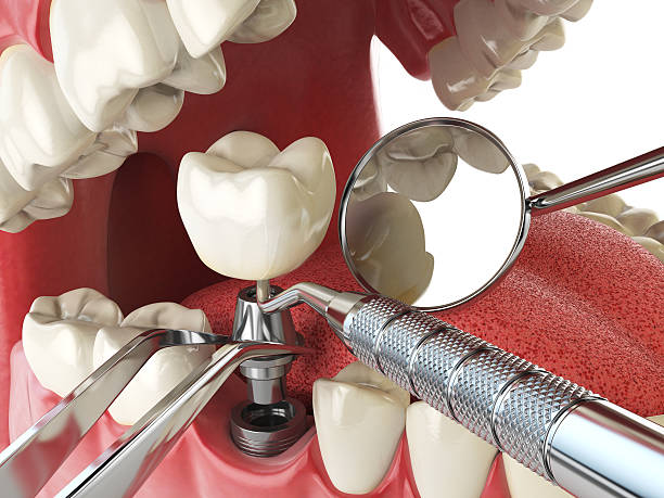 Best Lost Filling or Crown Replacement in Trevose, PA